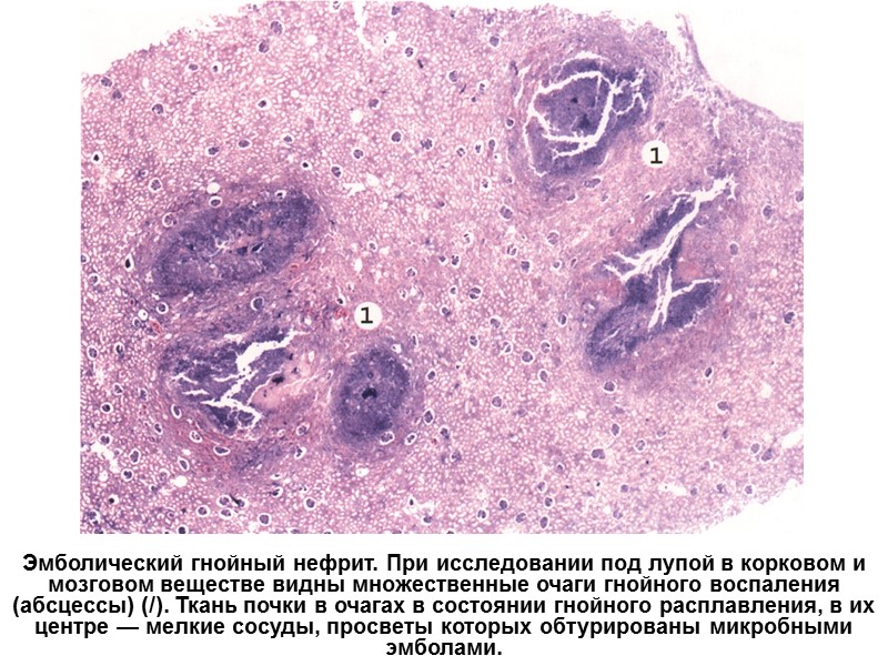 Эмболический гнойный нефрит. При исследовании под лупой в корковом и мозговом веществе видны множественные